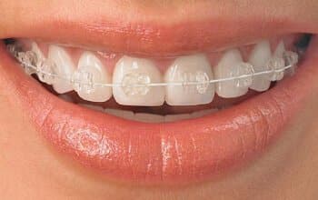 Teeth Alignment