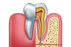 Periodontal Treatment